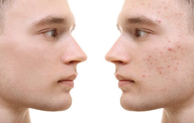 acne scarring cause