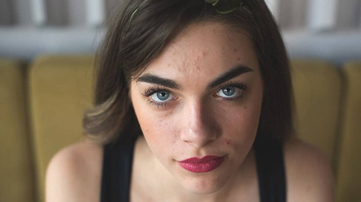 acne scarring cause female