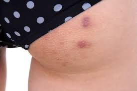 butt acne