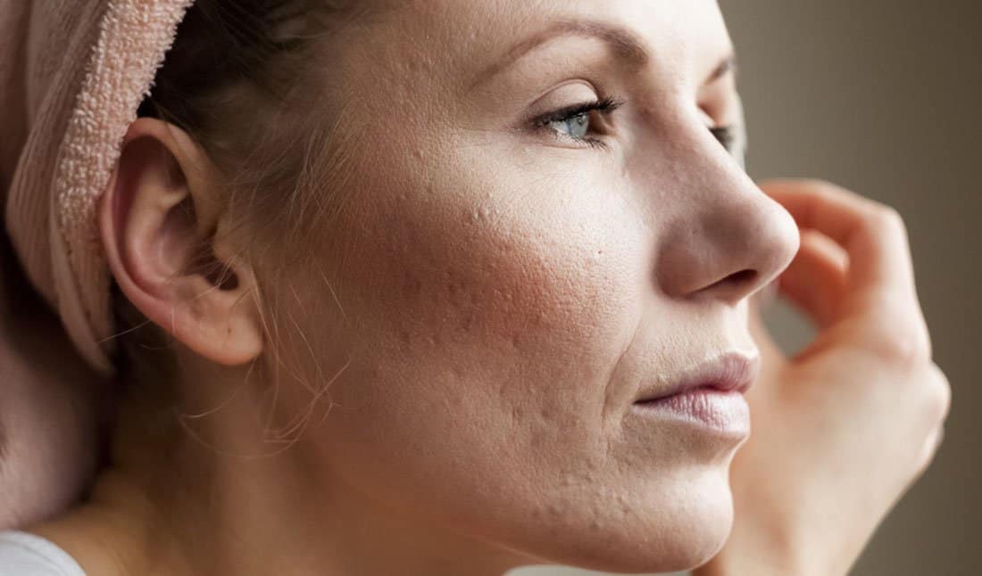 fade acne scars