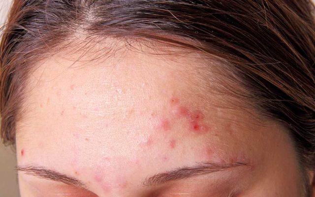 forehead acne